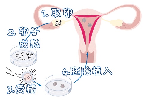 顕微授精 ICSI